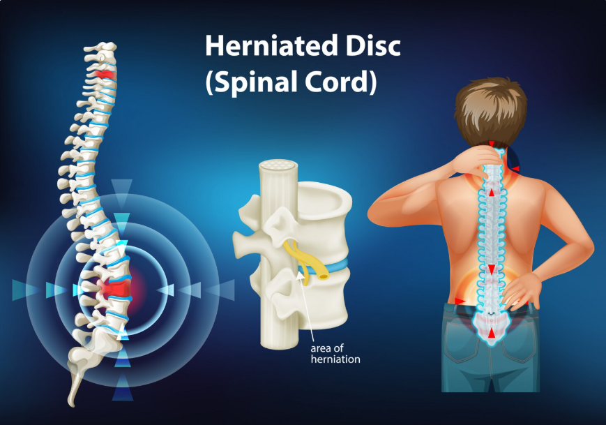 Herniated Disc & Bulging Disc